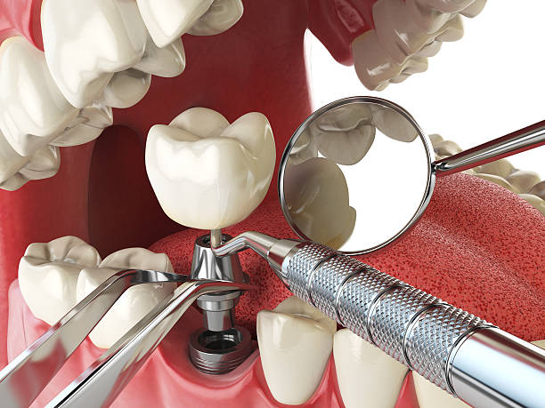 Best Broken or Cracked Tooth Emergency Dentist in Menlo Park, CA